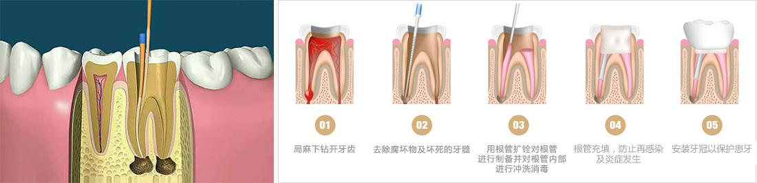 【一张图】带你认识根管治疗