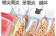 02/根尖周病
