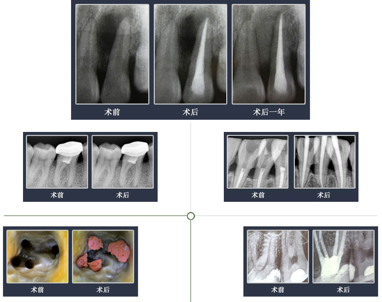 光大根管治疗技术经典病例