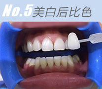 No5.美白后比色