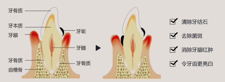 超声波洗牙优势