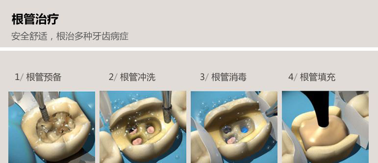 根管治疗牙周病