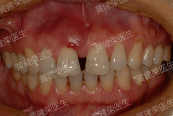 黃建(jian)榮醫生 牙齦反復腫脹溢膿包包可，牙  lan)湎  xi)增寬修復案列