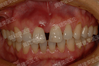 黄建荣医生 牙龈反复肿胀溢脓，牙间隙增宽修复案列