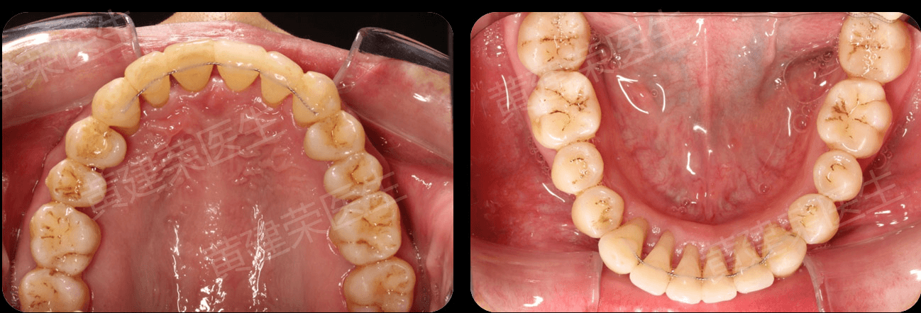 黃建榮醫生 牙周病導致的牙齒嚴重移位修(xiu)復案列