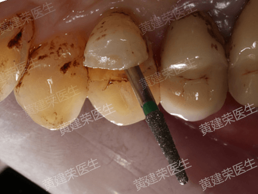 黄建荣医生 牙齿严重裂开修复案列