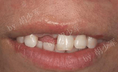 胡少軍醫生 牙齒缺失種植牙修復