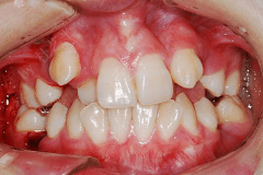 杜藝平醫生 牙齒不齊矯正案例(li)