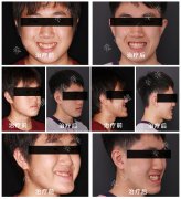 辛萍医生 地包天矫治案例