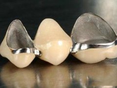 紫金县口腔科普：你知道烤瓷牙和美容冠有什么不 