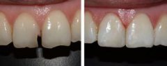 紫金县牙齿断裂一半可以用烤瓷牙修复吗 