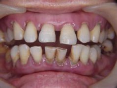 紫金县牙齿修复的方法主要有哪些 
