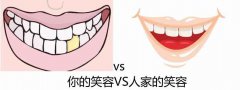紫金县牙齿美白能维持多久,大概几年? 
