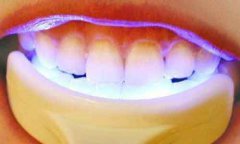 紫金县冷光美白牙齿适合人群有哪些? 