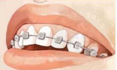 紫金县做牙齿矫正“期间”要注意什么 